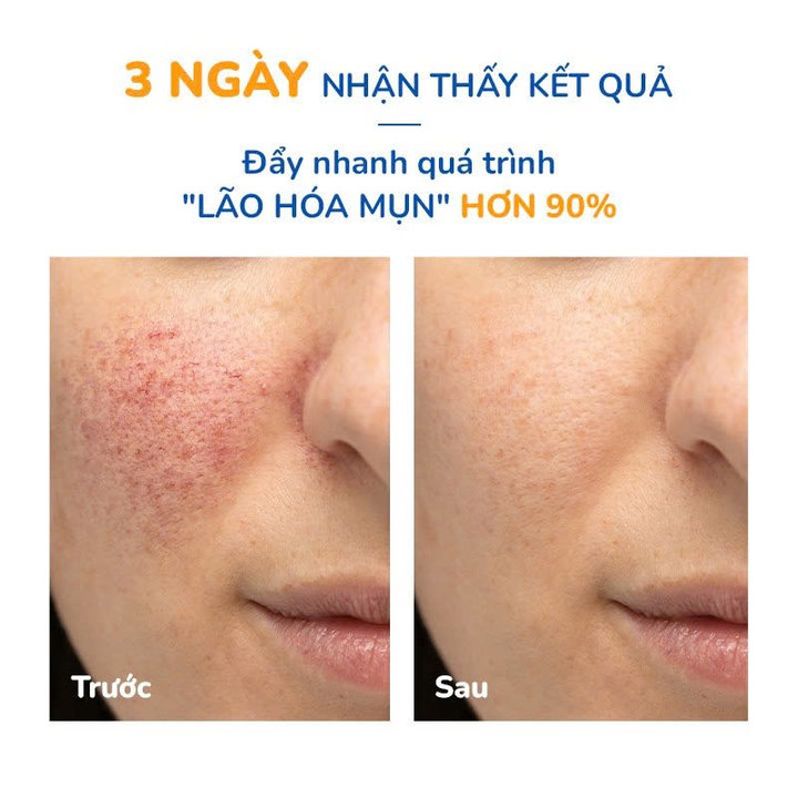 Combo 2 Tuýp Gel Giảm Mụn Thâm Sẹo Neothera Acnes